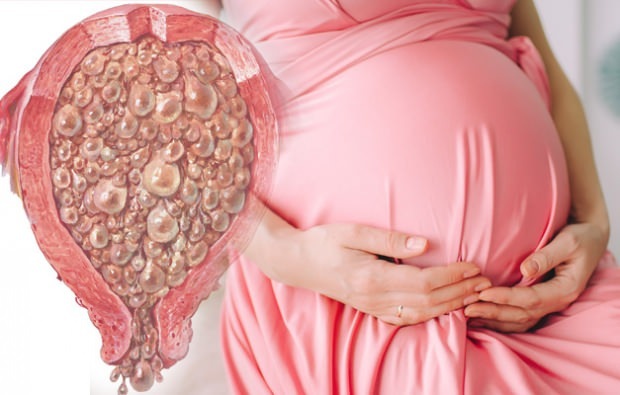 Što je trudnoća grožđa, simptomi trudnoće grožđa
