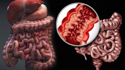 Što je Crohnova bolest? Koji su simptomi Crohnove bolesti? Postoji li lijek za Crohna?
