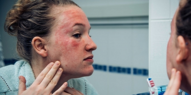 pojavljuju se na koži osobe s hladnom alergijom