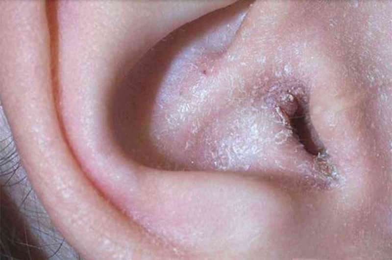 Što uzrokuje ljuštenje iza uha i kako prolazi? Definitivno rješenje za ekcem iza uha ...