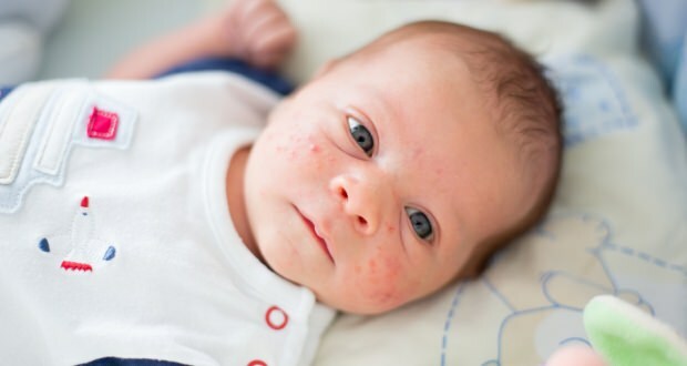 Kako akne prolaze na djetetovom licu? Metode sušenja protiv akni (Milia)