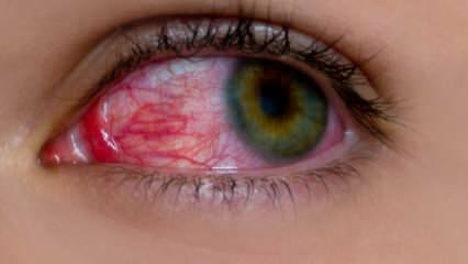 Što uzrokuje alergiju očiju? Koji su simptomi očne alergije? Što je dobro za očne alergije? 