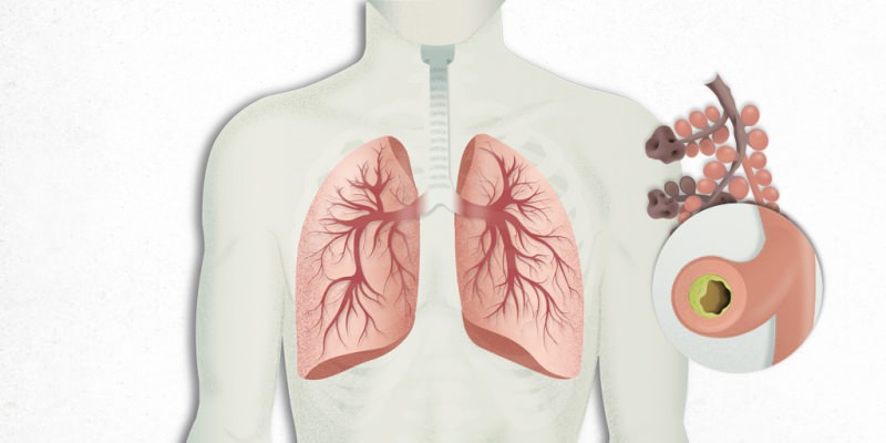 virus koji se naseljava u plućima pomiješan je s pneumonijom