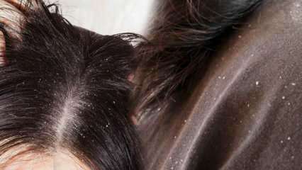 Kako prolazi perut i što je dobro za kosu protiv peruti? 5 najbržih i najučinkovitijih metoda uklanjanja peruti