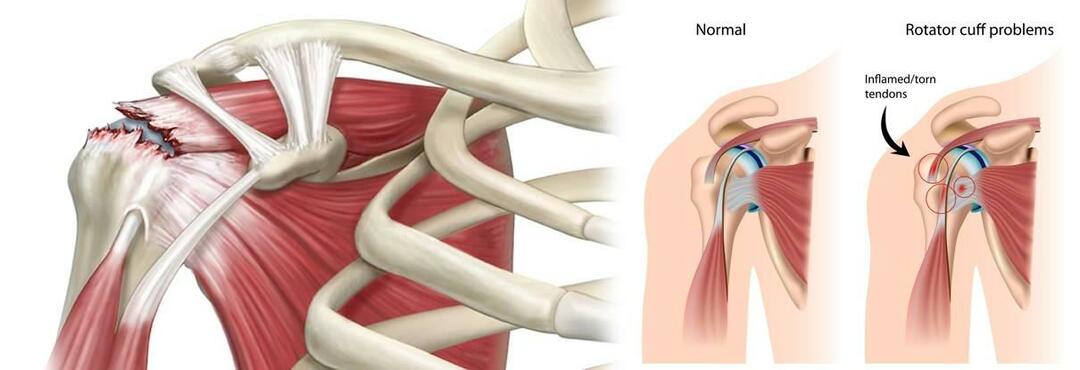 Zašto dolazi do puknuća ramena? Kako se liječi razderotina ramena?