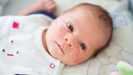 Kako akne prolaze na djetetovom licu? Metode sušenja protiv akni (Milia)