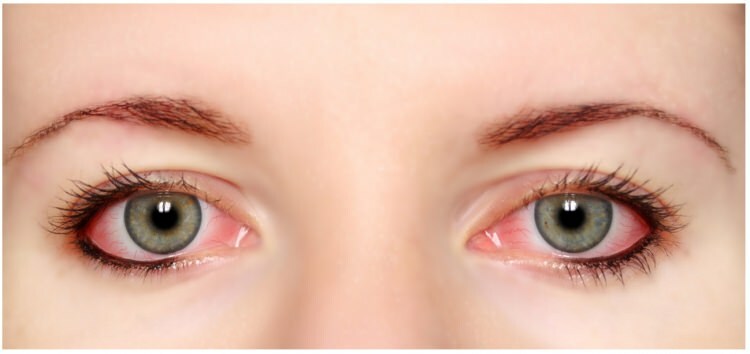 Ima li maskara i eyeliner alergija na očima?