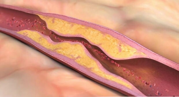 Što uzrokuje aterosklerozu? Koliko postoji vrsta vaskularne okluzije?