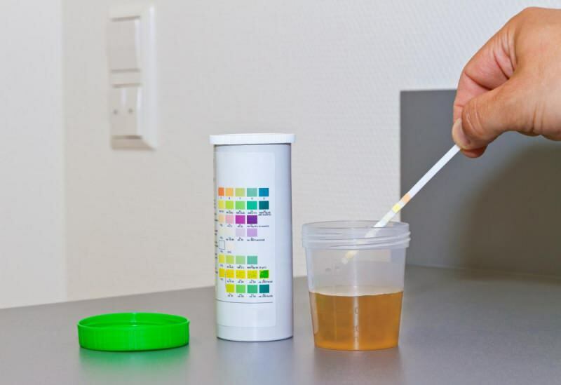 razina bilirubina obično se javlja u testu urina