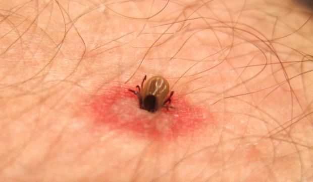 Kakav ubod insekata je? Simptomi uboda insekata! Prirodna metoda uboda komaraca