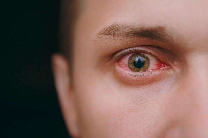 simptomi koronavirusa, zalijevanje očiju, krvarenje i svrbež