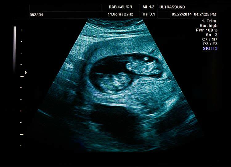 Čimbenici koji utječu na rođenje u blizanačkoj trudnoći