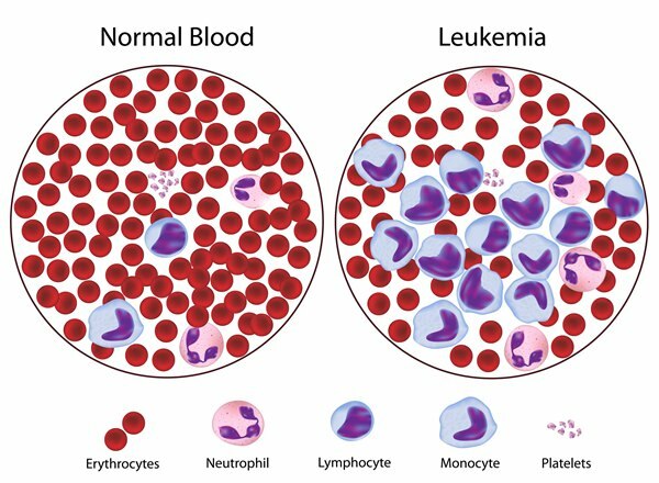 što je leukemija