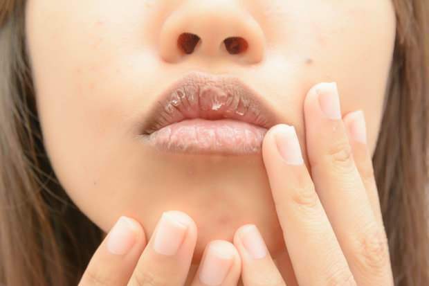 anemija uzrokuje suhe usne