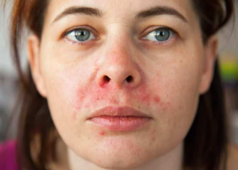 Zašto se akne pojavljuju oko usne? Kako se liječi periferni dermatitis?