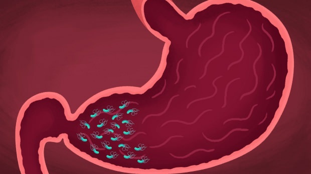 neki virusi i bakterije mogu izazvati gastritis