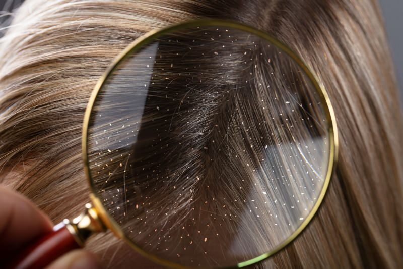 Kako prolazi perut i što je dobro za kosu protiv peruti? 5 najbržih i najučinkovitijih lijekova protiv peruti