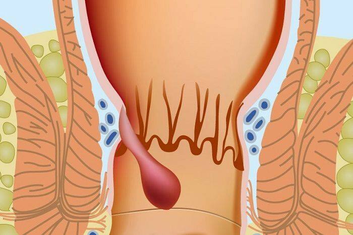 Kako se hemoroidi javljaju u analnom dijelu 