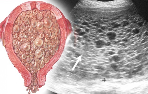 Što su trudnoća grožđa simptomi trudnoće grožđa