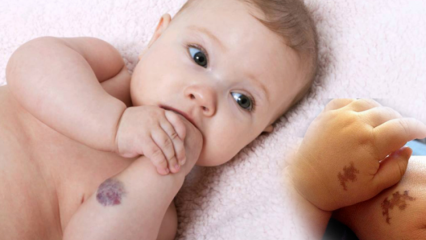 Uzrokuje rodni žig kod beba, je li trajan? Koje su vrste rodnih žigova? Lijek iz Saracoglua