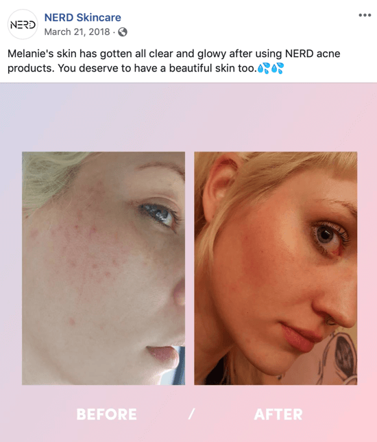 Primjer kako je Nerd Skincare koristio sliku prije i poslije kako bi stvorio slikovni post za društvene medije koji potiče kupnje njihovih proizvoda.