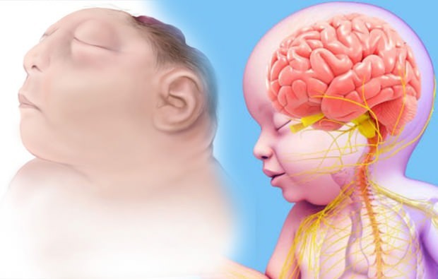 Živi li beba Anencefalija? Anencefalna dijagnoza