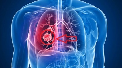 Simptomi raka pluća: stadijumi raka pluća!