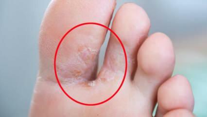 Što je gljiva na stopalima? Koji su simptomi atletskog stopala? Liječenje atletskog stopala 