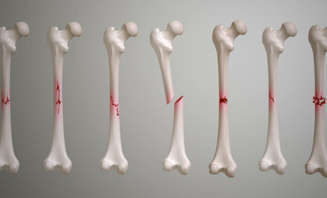 Što je ključna kost? Koliko je potrebno da prijelom ključne kosti zaraste?
