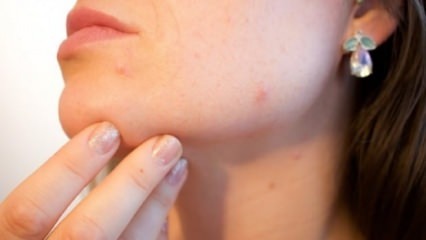 Prirodni lijek protiv akni na bradi