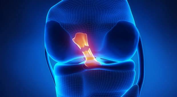 Što uzrokuje puknuće križnog ligamenta i koji su simptomi? Postoji li križni ligament?