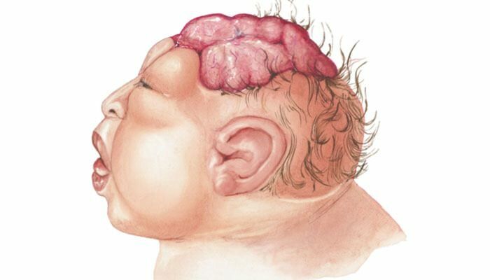 Što je Anencefalija? Koji su simptomi Anencefalije u dojenčadi i djece? Anencefalija uzrokuje ...