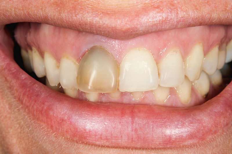 potamnjenje zuba ponekad se može koncentrirati na jedan zub