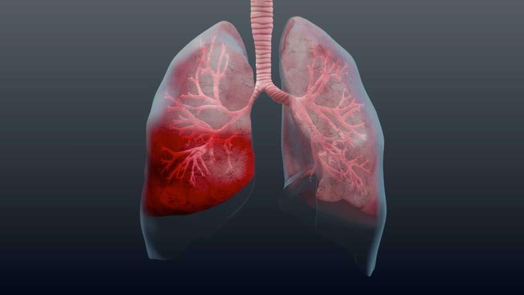 Što je upala pluća i koji su njezini simptomi? Kako se liječi nova epidemija Pneumonia virus?