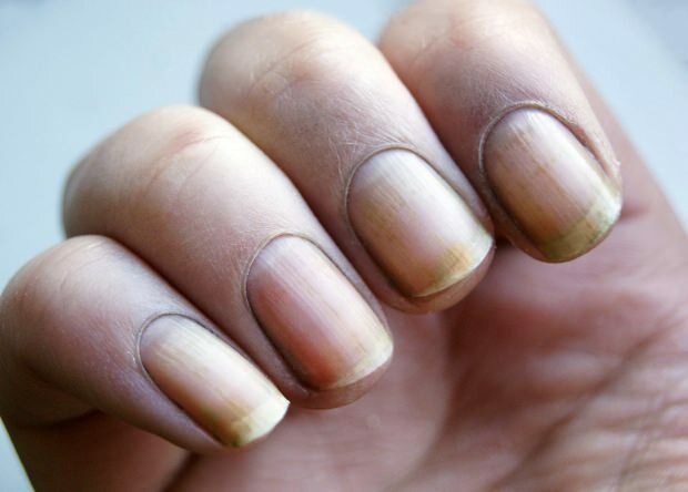 Zašto nokat žuti? Kako izbjeliti nokte koji požute od laka za nokte?