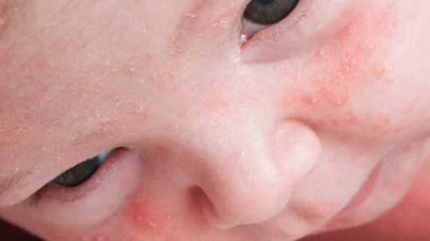 Kako akne prolaze u dojenčadi?