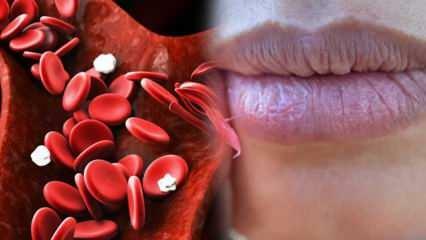 Što je anemija? Stalna slabost znak je anemije! Hrana koja je dobra za anemiju ...