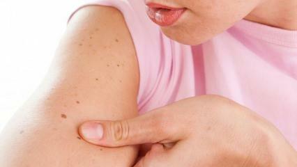 Što je rak kože (kože) i koji su njegovi simptomi? Načini razumijevanja raka kože