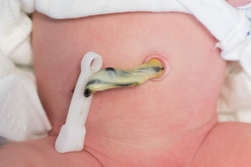 Kada se prereže pupčana vrpca kod beba? Prednosti kasnog rezanja pupčane vrpce