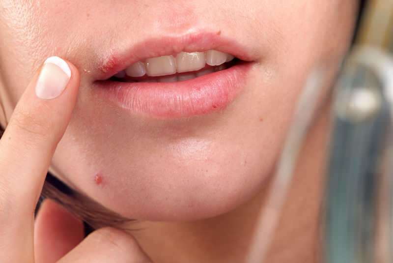 herpes obično izlazi na rubu usne.