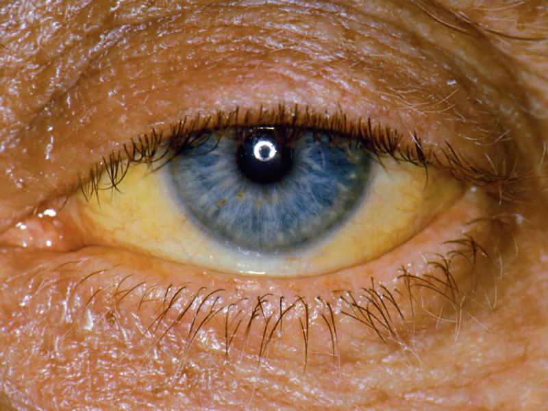 visina na razini bilirubina uzrokuje žutu boju očiju i kože