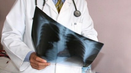 Najavili su stručnjaci! Povećanje smrtnosti od raka pluća