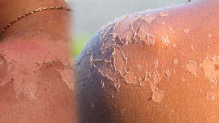 Što je dobro za piling kože i kako je piling kože? Kućni lijek za piling kože