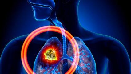 Koji su simptomi raka pluća? Postoji li liječenje raka pluća?