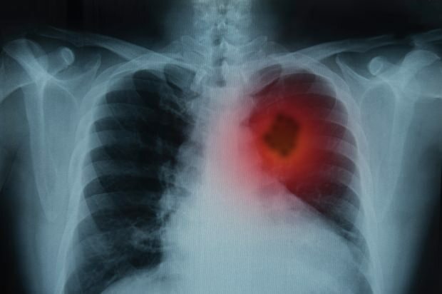 Koji su simptomi raka pluća? Postoji li liječenje raka pluća? Za sprečavanje raka pluća ...