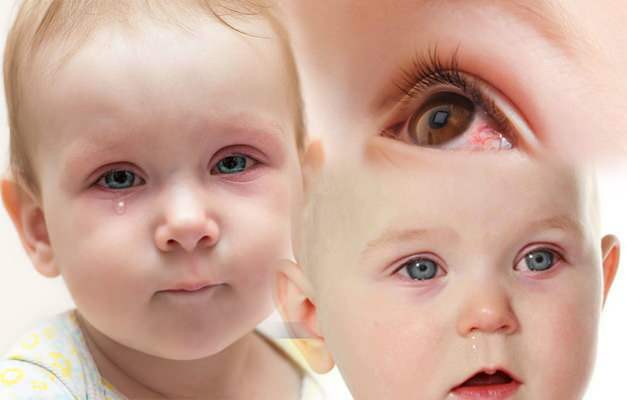uzrokuje krvarenje iz oka kod beba