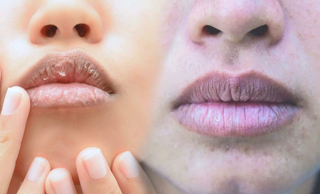 Što uzrokuje tamne usne? Kako se liječe tamne usne ili modrice?