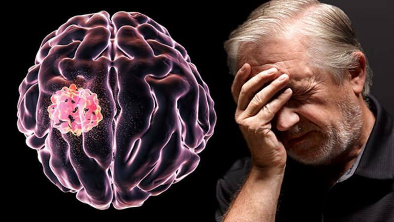 Tkivo nastalo u mozgu poremećajem staničnih struktura naziva se tumor.