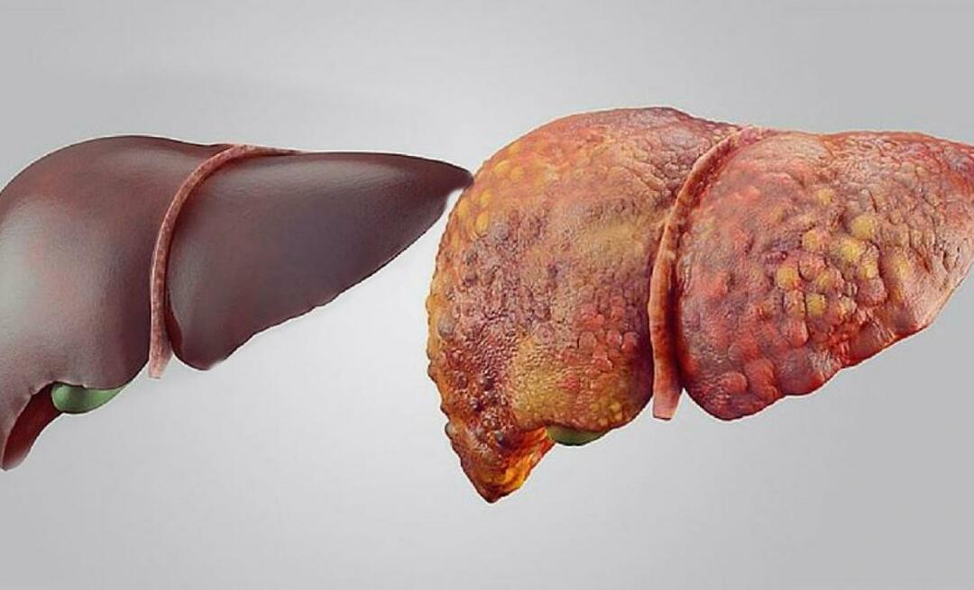 Koji su simptomi zatajenja jetre? Kako se liječi zatajenje jetre?