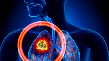 Koji su simptomi raka pluća? Postoji li liječenje raka pluća? Za sprečavanje raka pluća ...